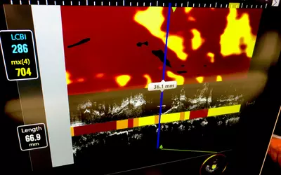 Example of intravascular ultrasound (IVUS) from the Acist HDi system on the expo floor at ACC23.