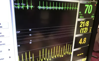A PA catheter hemodynamic waveform measuring pulmonary artery pressures as part of a hands-on cardiac critical care simulator at ACC.23. #ACC23