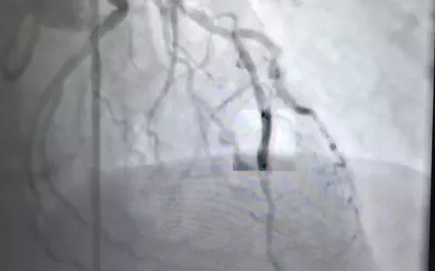 A stent enhancement and image stabilization feature on angiography demonstrated by Siemens a ACC 2023. #ACC #ACC23