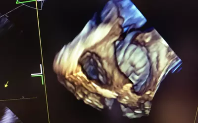 A Watchman left atrial appendage (LAA) occluder seen on 4D ICE in the GE Booth.