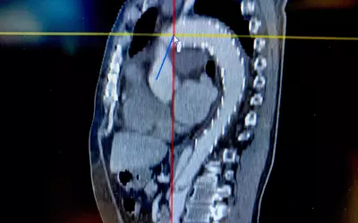 Aortic aneurysm with thoracic stent graft above CT Sectra HIMSS23 DF