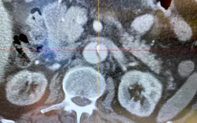 Aortic aneurysm on CT, Sectra HIMSS23.