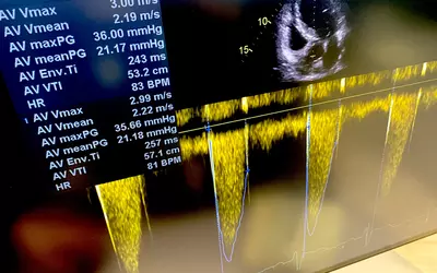 Cardiac ultrasound echo on Sectra CVIS at HIMSS23.