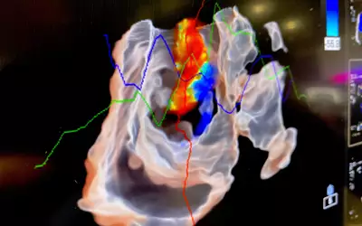 An example of the blood flow through valves seen using the glassview visualization option that helps see through underlying tissues on the Philips 3D/4D ICE system.