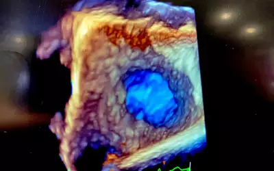 A view of the  left atrial appendage (LAA) in 3D/4D ICE in the Philips booth at HRS 2023. #HRS2023