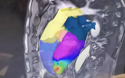 MRI-guided EP lab ablation procedure using mapping and MRI-safe catheters from Imricor, displayed at HRS 2023. Photo by Dave Fornell