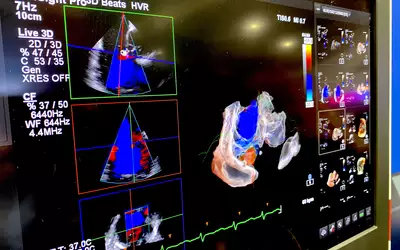 A left atrial appendage (LAA) measurement assessment using the Philips 3D/4D intracardiac echo (ICE). This can help size the LAA during procedures for the correct occluder device fit.