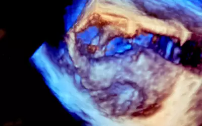 An example of 3D ICE showing a vegetation clot formed on a valve using the Philips ICE system in a demo at ASE.