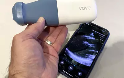 The Vave wireless POCUS ultrasound probe works with an app to turns a smartphone into an ultrasound system.