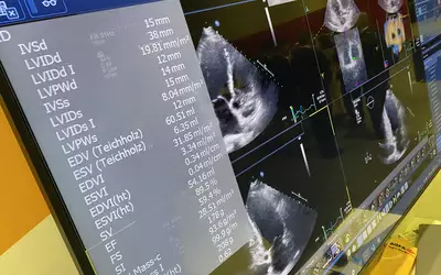 Automated echo measurements on the Agfa echo reporting system in its enterprise cardiovascular information system (CVIS) demonstrated at ASE 2023. These types of automation were highlighted across the expo floor to help improve accuracy, consistency and speed workflows. #ASE #ASE2023 #CVIS #echo