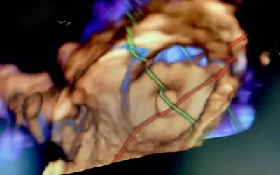 Deployed Watchman left atrial appendage (LAA) occluder visualized on Siemens' 3D intracardiac echo (ICE) technology demonstrated on the expo floor at ASE 2023. #ASE23