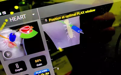 Example of AI-assisted echo exam guidance on the Echonous Kosmos POCUS system. The thumbnail picture of the chest, target area and transducer show the user how to position and move the transducer to get better quality cardiac images.