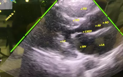Echonous Kosmos POCUS AI guidance to perform echo exam ASE23. An example of AI guidance technology to help novice ultrasound users perform a diagnostic quality echo on the Echonous Kosmos POCUS system. The green bars show the quality of the imaging window and anatomy to capture imaging of the heart is specific views. The system also has a thumbnail image of the chest and transducers to show how to move it to get the correct views.