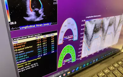Medis QStrain Echo software for strain at ASE 2023. 