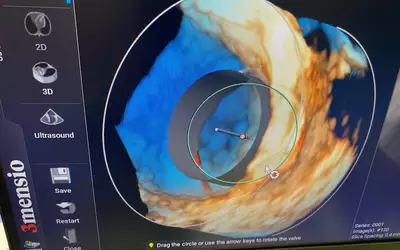 Pie Medical echo analysis software of Edwards Sapian TAVR valve in mitral position for TMVR planning ASE23.