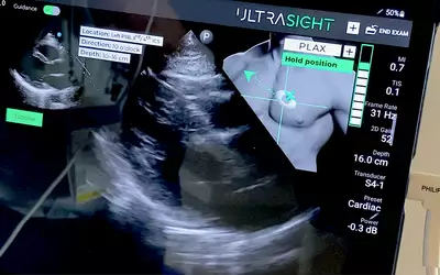 Example of a live POCUS cardiac scan with AI guidance technology to help the user get diagnostic quality echos using the Ultrasight AI system. The AI uses a thumbnail image of the chest and transducer with a target area marked to show where and how to move the transducer. A bar graph on the right side of the thumbnail image shows the quality of the image being acquired and will go up has the user gets into a more ideal imaging window with the correct anatomy in frame. 