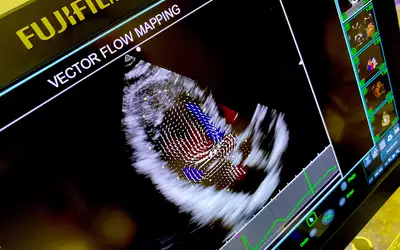 Vector flow imaging echo ultrasound Fujifilm 2023 ASE.