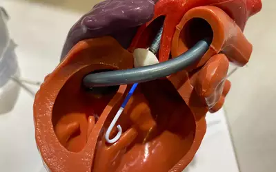 Biventricular Impella hemodynamic support using an Impella RP and an Impella. Demonstration model in the Abiomed booth at TCT 2023. Photo by Dave Fornell