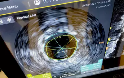 IVUS measurements displayed by Philips at TCT 2023. Photo by Dave Fornell