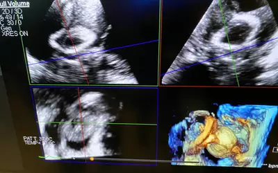 View of a MitraClip after capture of both mitral valve leaflets using the HD Live surgical view imaging feature on the GE Vivid e95 echocardiography system. Read more on advances in structural heart echo imaging.