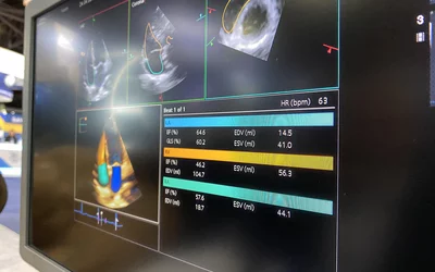 AI automated strain on the new Siemens Origin echo system at ACC24.