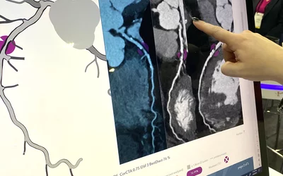 Heartflow Roadmap AI can show the locations and severity of coronary lesions from a CT scan to act as a second set of eyes for imagers, and to better inform referring physicians and patients.