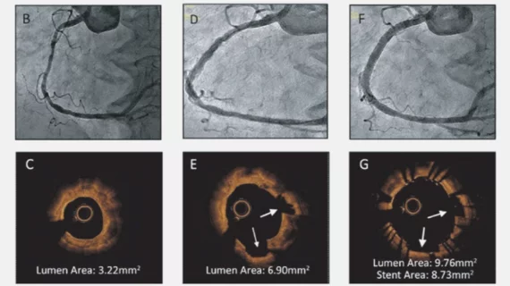 A comparison of before and after angiography images (top) and optical coherence imaging (OCT - below) showing the impact of intravascular lithotripsy (IVL) in coronary arteries in the DISRUPT CAD III trial. 