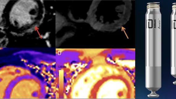 Top cardiology stories in Cardiology Business magazine in February 2022. The top stories this month included new information on COVID vaccine caused myocarditis and the FDA clearance of the first transcatheter dual-chamber leadless pacemaker system from Abbott.