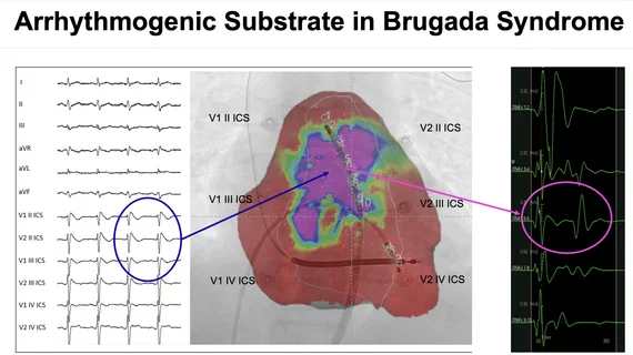 Brugada arrhythmogenic substrate that causes VT and sudden cardiac death. This study showed ablation of this substrate area could help prevent sudden cardiac arrest in these patients.