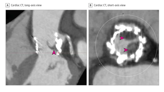 Subclinical leaflet thrombosis after TAVR imaged by CT. The areas of clot attached to the valve leaflets appear dark. Image courtesy of Cahill et al. and JAMA Cardiology.