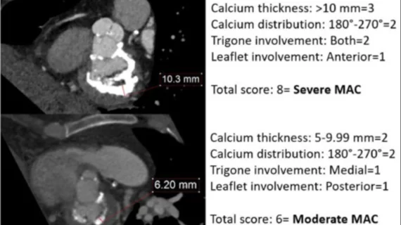Mitral annular calcium (MAC) does not appear to have a negative effect on long-term transcatheter aortic valve replacement (TAVR) outcomes, according to new research published in the American Journal of Cardiology.