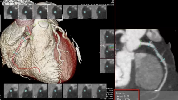 A coronary computed tomography angiography (CCTA) scan assessment to show blockages in the arteries noninvasively for better risk assesments without needing to catheterize a patient. Image from the Canon Vitrea software.