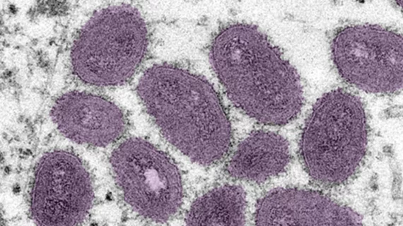 monkey_pox_nih_image.png monkey_pox_nih_image.png