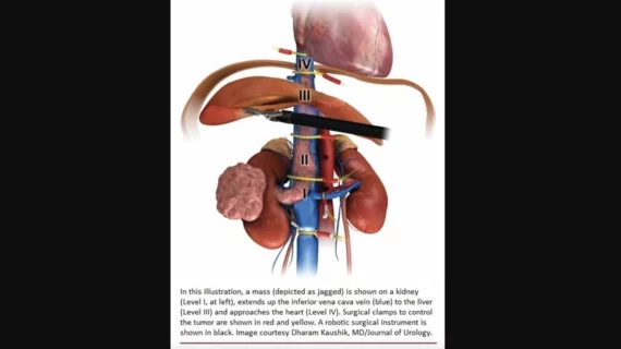 When kidney cancer invades a patient’s inferior vena cava (IVC), robotic-assisted radical nephrectomy with IVC thrombectomy is a safe and effective alternative to open surgery, according to a new meta-analysis published in the Journal of Urology.[1] 
