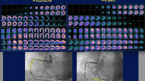 Comparison of flurpiridaz F-18 PET, SPECT and angiography of the 60-year-old female patients in the Aurora trial. The SPECT scan appeared normal, but flurpiridaz was shown to be more sensitive and showed the ischemia from two blockages in the right coronary artery. The new radiotracer may help expand cardiac PET. #ASNC