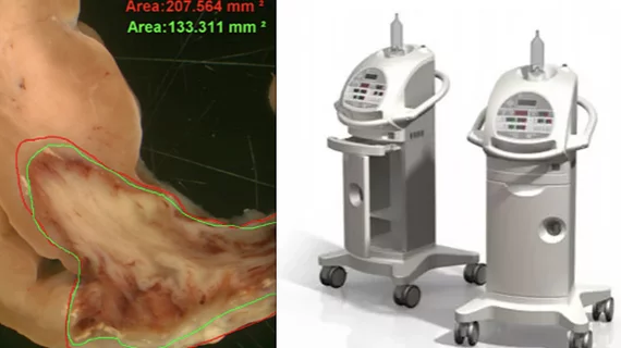 Thermedical SERF thermal ablation system for VT.