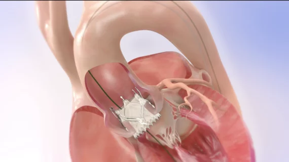 JenaValve transfemoral TAVR system.
