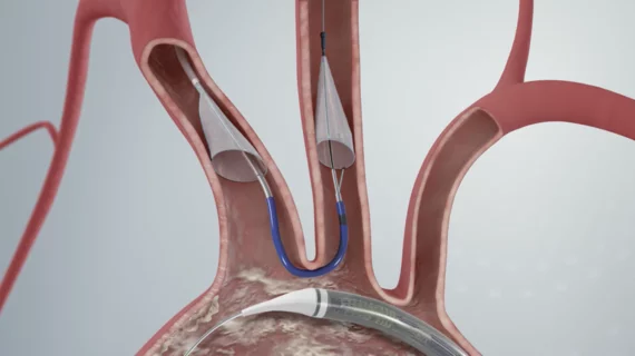 The Boston Scientific Sentinel embolic protection system was tested in the PROTECTED TAVR to see if it couple prevent or reduce stroke and disabling stroke numbers during TAVR. #TCT22 #TCT2022. 