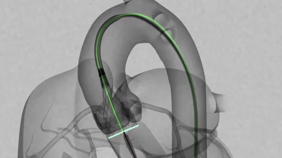 Medtronic launches Evolut FX TAVR system aortic stenosis. 