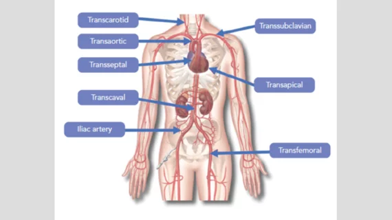 transcarotid TAVR TAVI transcatheter aortic valve replacement
