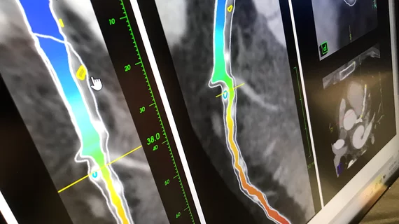 Example of fractional flow reserve (FFR) calculated using AI and assessment of the plaque in the vessel on a CT scan of the coronaries. This new type of FFR-CT was shown as a work-in-progress by the vendor Elucid. It was shown for the first time at AHA 2022.