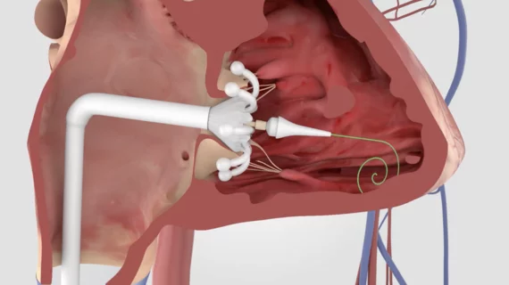 Edwards Lifesciences Corporation has shared new one-year data on the safety and effectiveness of its Evoque transcatheter tricuspid valve replacement (TTVR) system among patients with tricuspid regurgitation (TR)