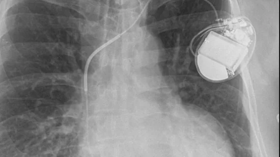An example if an implantable cardioverter defibrillator (ICD and its leads connected to the heart. As the leads or deveice wears out, there are recommendations to remove the leads and put in new ones. The most common causes of mortality during transvenous lead removal (TLR) in patients with cardiac implantable electronic devices (CIEDs) are infection and decompensated heart failure, according to new research published in JACC: Clinical Electrophysiology.Image courtesy of RSNA