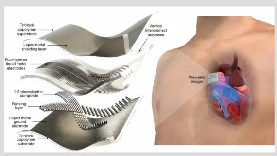New wearable device, no bigger than a stamp, uses AI to deliver on-the-go cardiac imaging