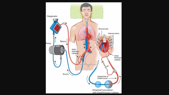 Extracorporeal CPR refractory out-of-hospital cardiac arrest