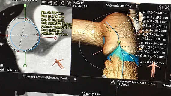 An example of virtual pulmonary valve implant planning software showing a virtual transcatheter pulmonary valve with measurements implnated in the virtual anatomy of a congenital heart patient. This was part of a training class at the Society of Cardiovascular Computed Tomography (SCCT) 2022 meeting.