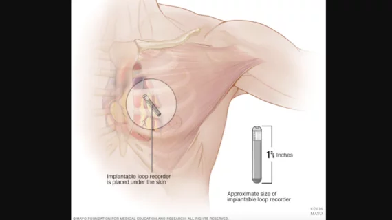 The increased use of implantable loop recorders (ILRs) is associated with identifying more bradyarrhythmias such as bradycardia, according to new findings published in JAMA Cardiology.