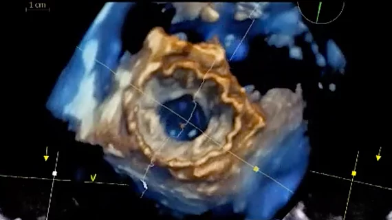 A 3D intracardiac echo (ICE) view of a surgical mitral valve using the NuVision ultrasound catheter developed by Biosense Webster in partnership with GE Healthcare.
