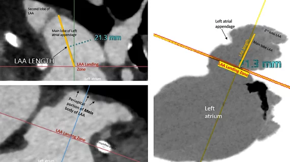 Images from the consensus document showing the proper left atrial appendage (LAA) sizing assessment for a transcatheter occluder device using transesophageal echo (TEE). Sizing and evaluation for pre-existing thrombus in the LAA also can be performed using cardiac CT.
