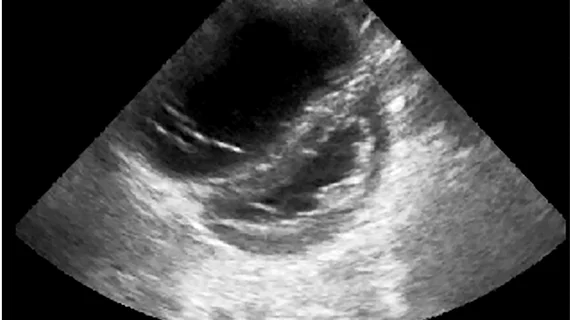 A figure from the ASE pediatric POCUS guidelines showing parasternal short-axis view demonstrating RV dilatation with bowing of the septum into the left ventricle, indicating pulmonary hypertension in this child with shock and pertussis.